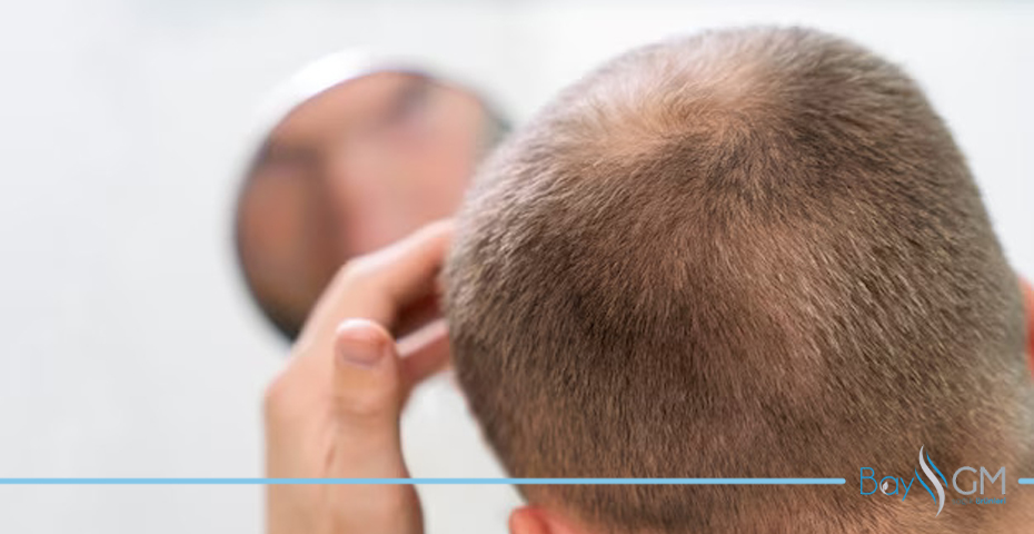 Diyet Kaynaklı Saç Dökülmesine Neden Olan Faktörler Nelerdir
